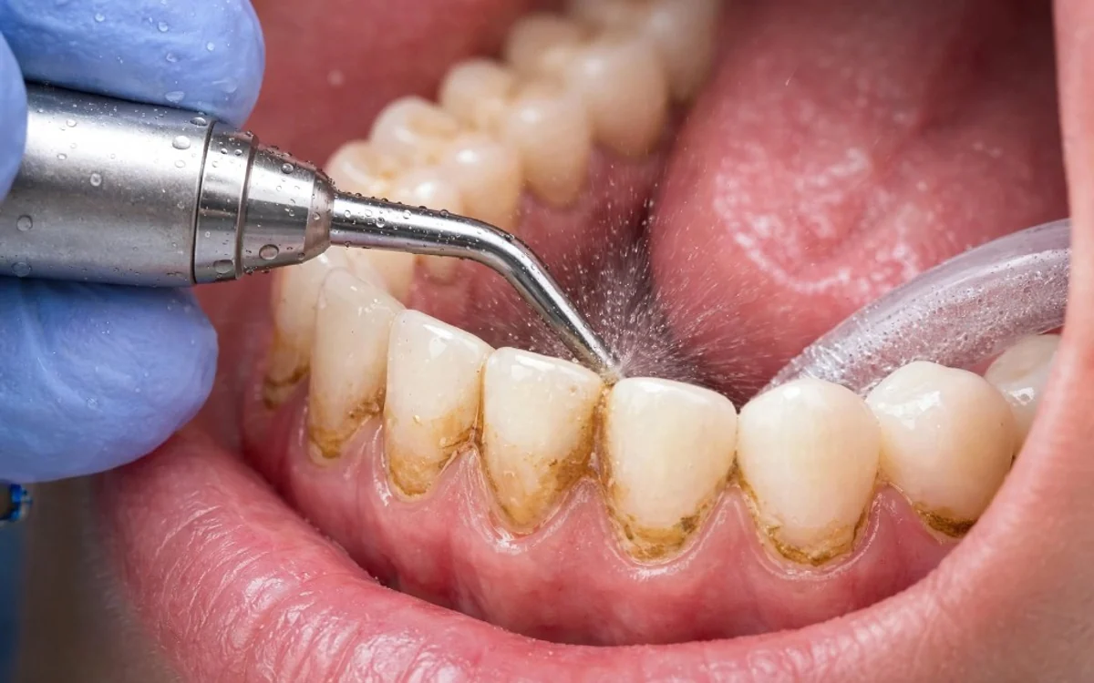 Gentle ultrasonic teeth cleaning and plaque polishing procedure