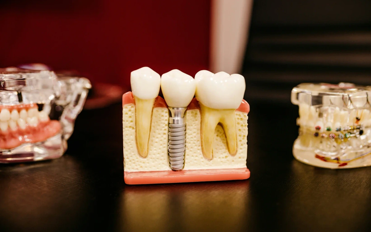 Dental implant model showcasing titanium root screw, abutment, and ceramic crown