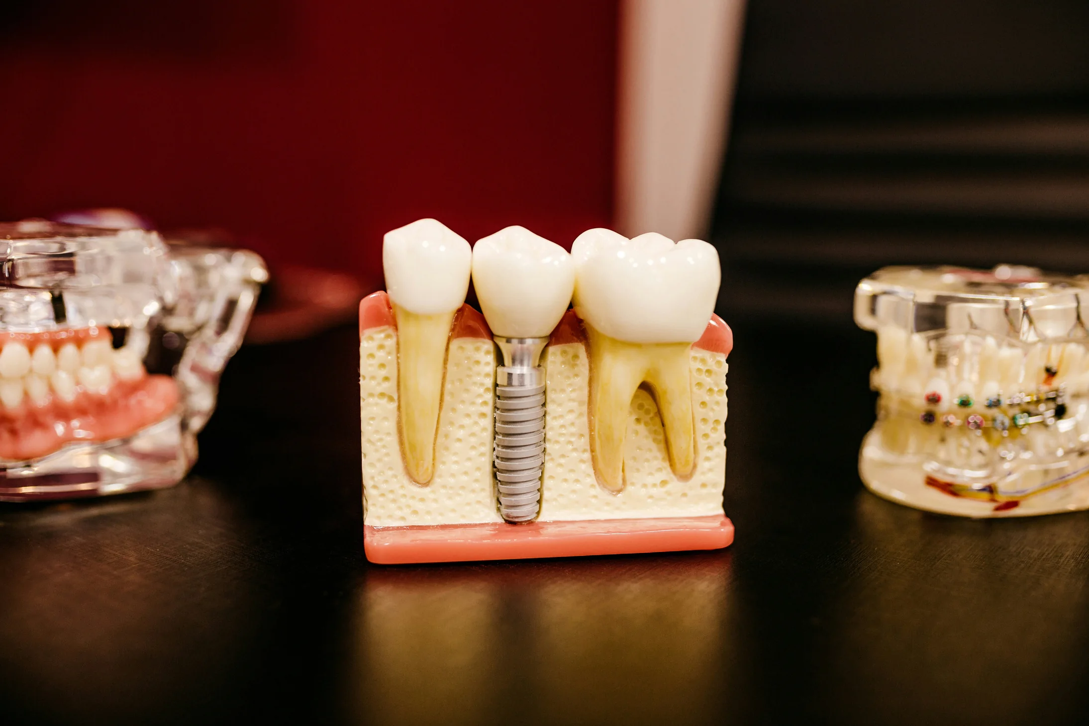 3D Guided Surgical Dental Implant cross-section in bone