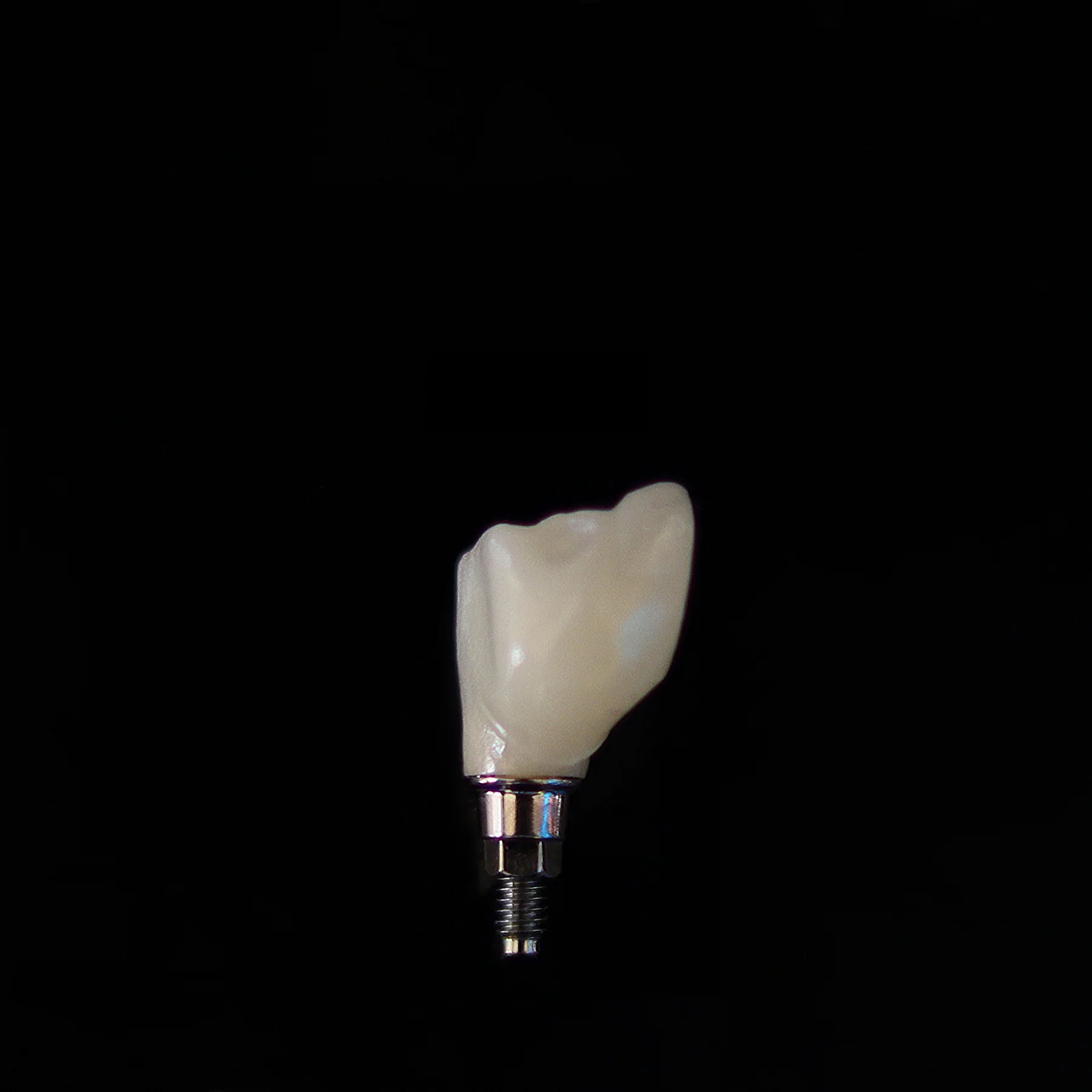 Milled Zirconia Implant Crown and Custom Titanium Abutment